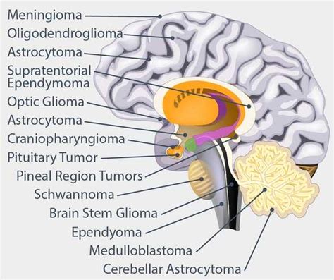 bain stem|types of brain stem tumors.